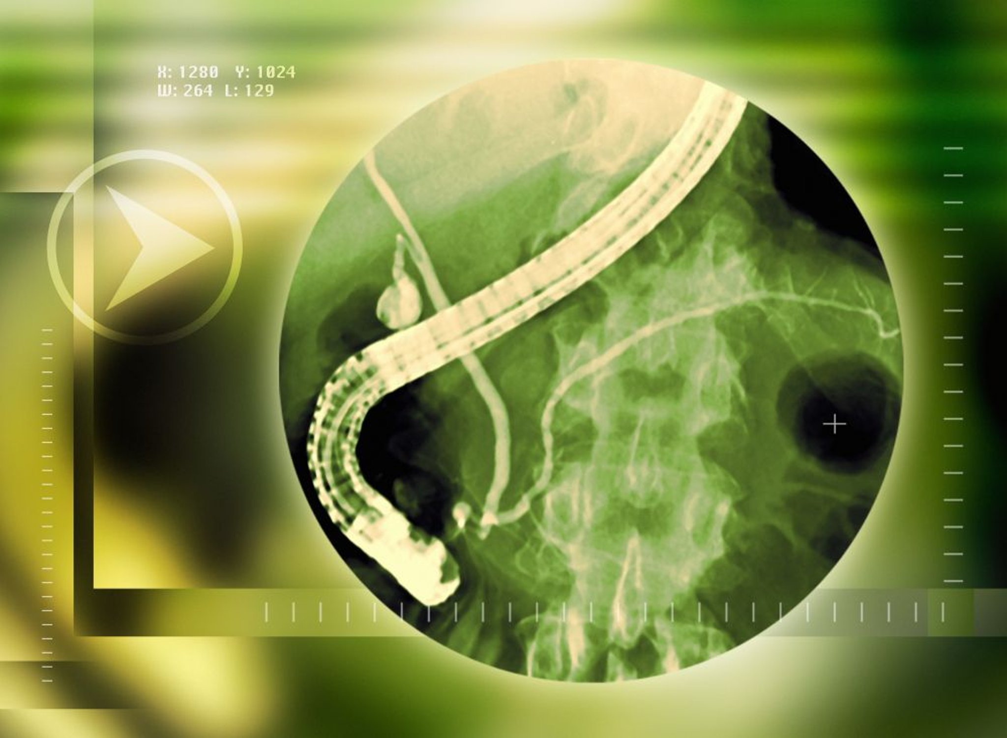 内镜逆行胰胆管造影（ERCP）