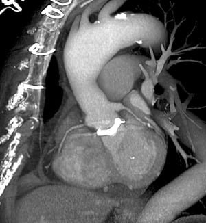TC cardiaca (scansione 3D della protesi valvolare cardiaca)