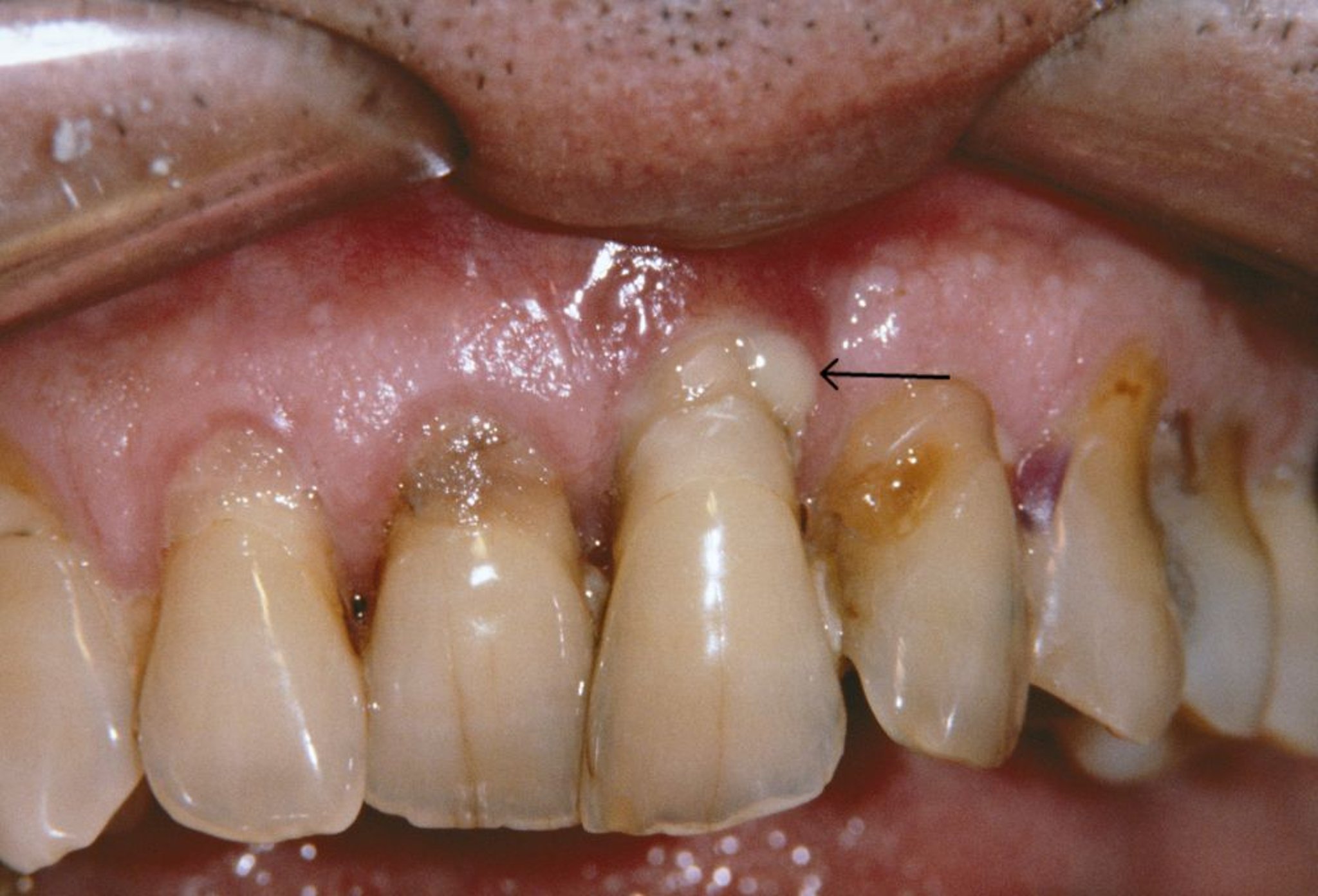 Periodontitis