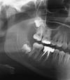 Impacted Wisdom Teeth