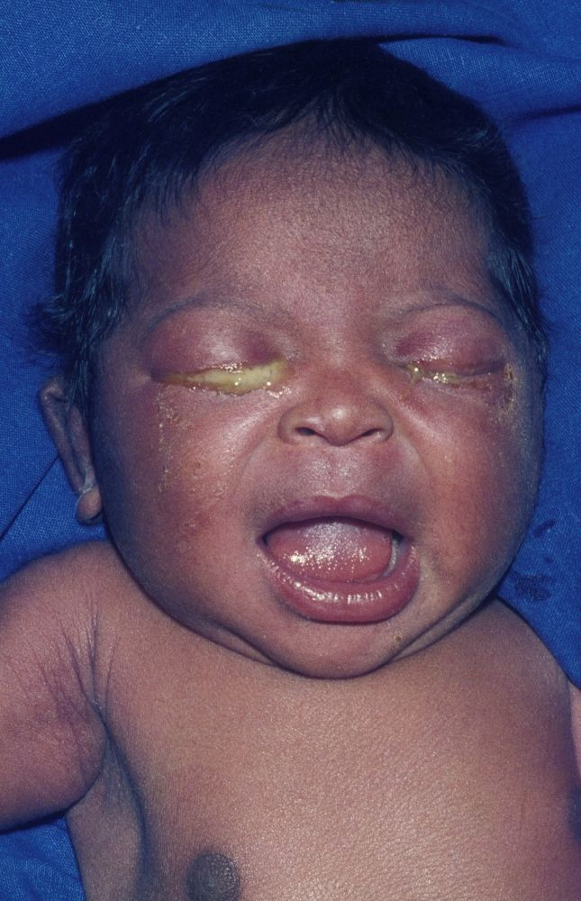 Офтальмія новонароджених