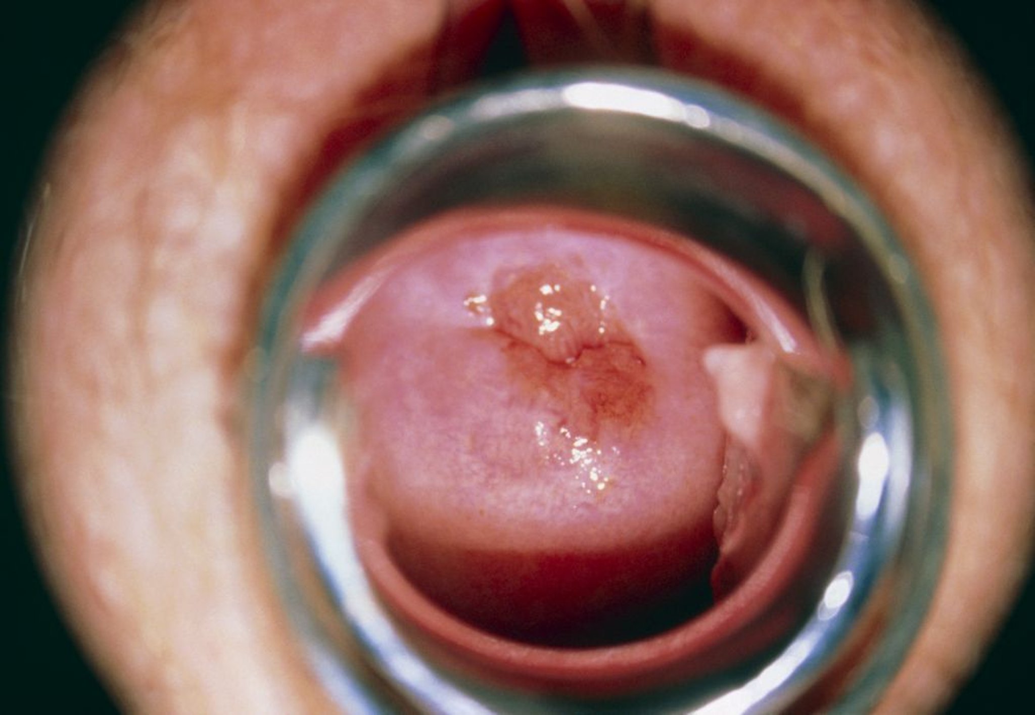 Cáncer de cuello uterino