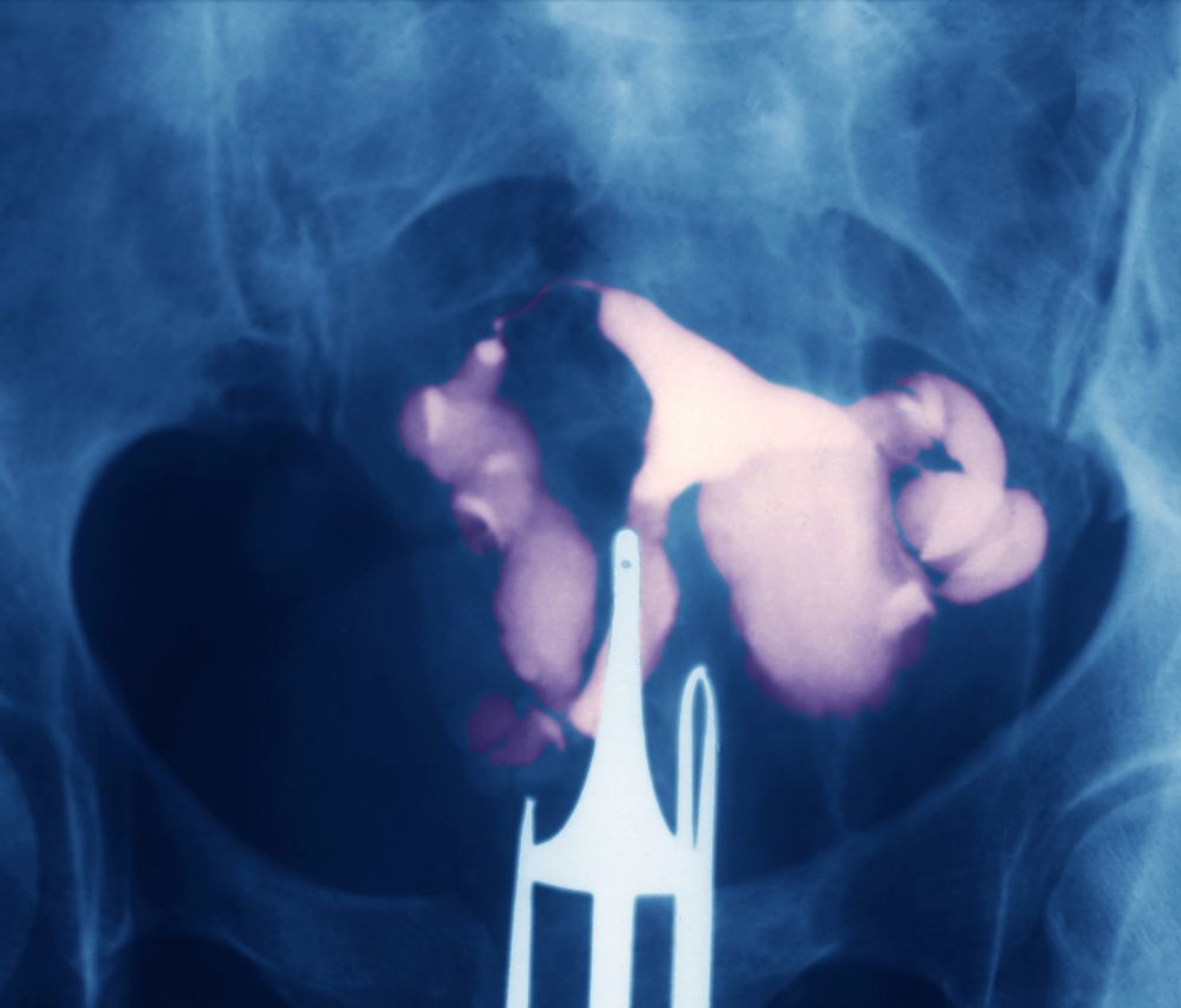 Fallopian Tube Obstruction