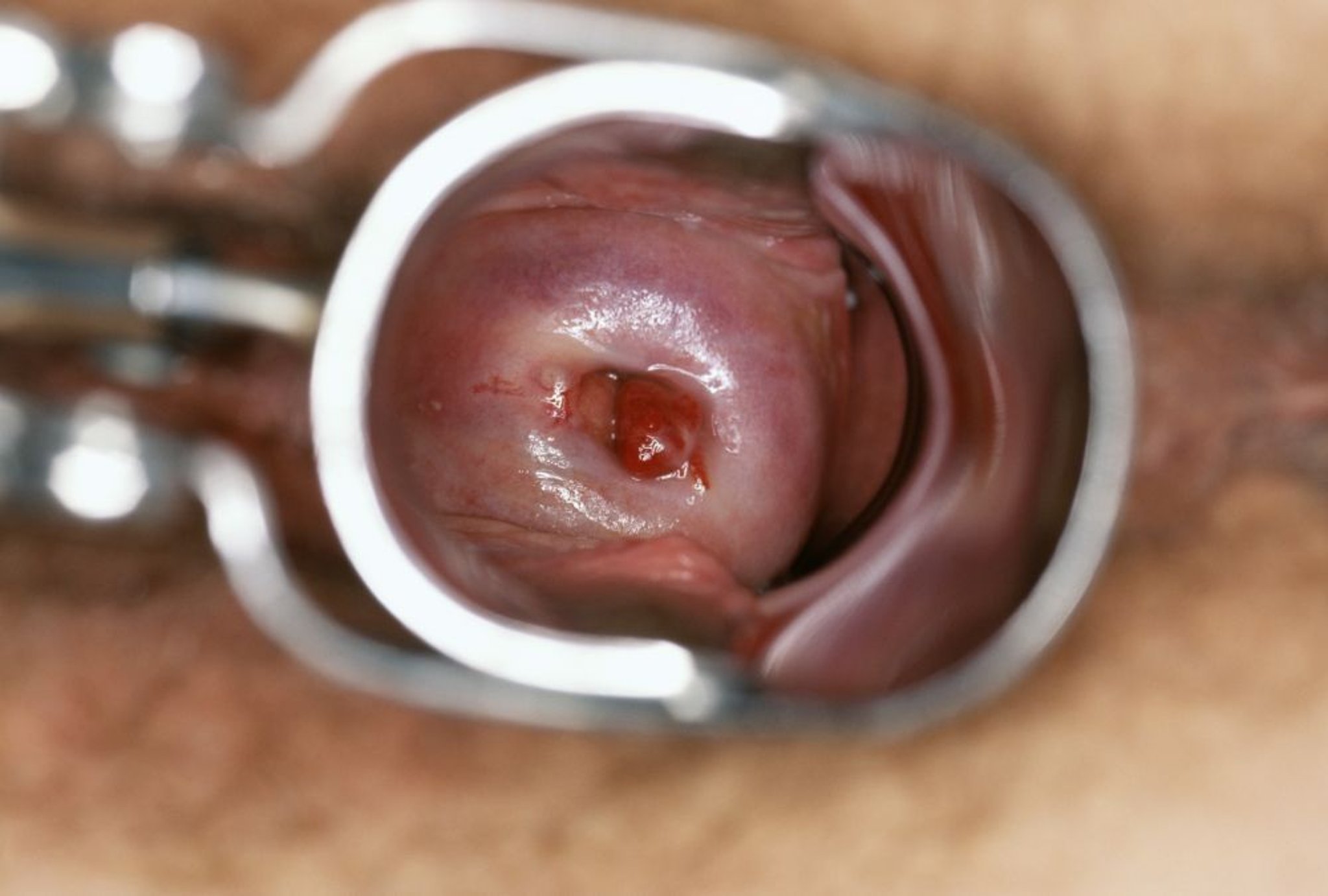 Polype cervical