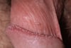 Papules et verrues péniennes perlées