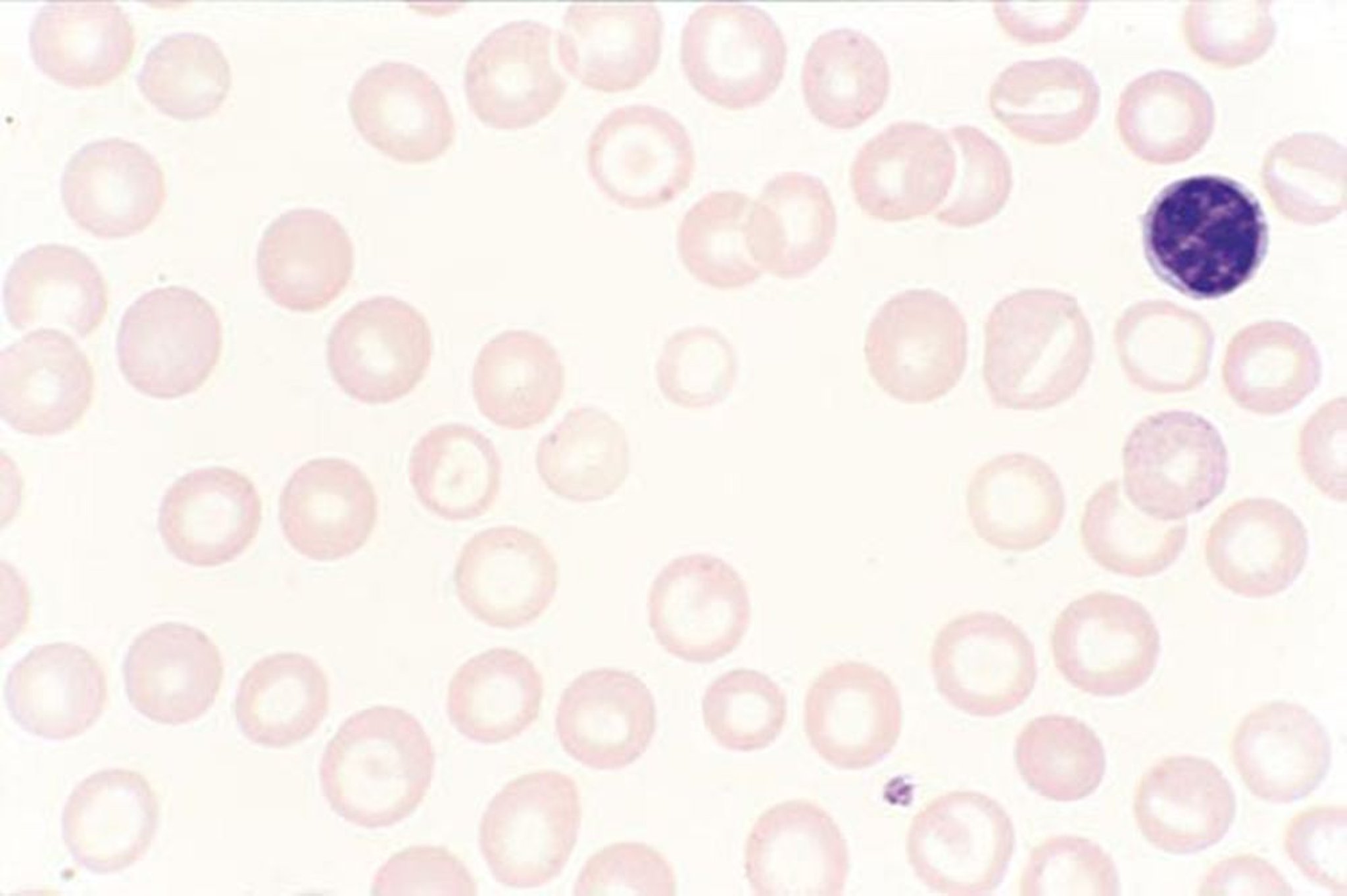 Macrocytose dans les maladies du foie
