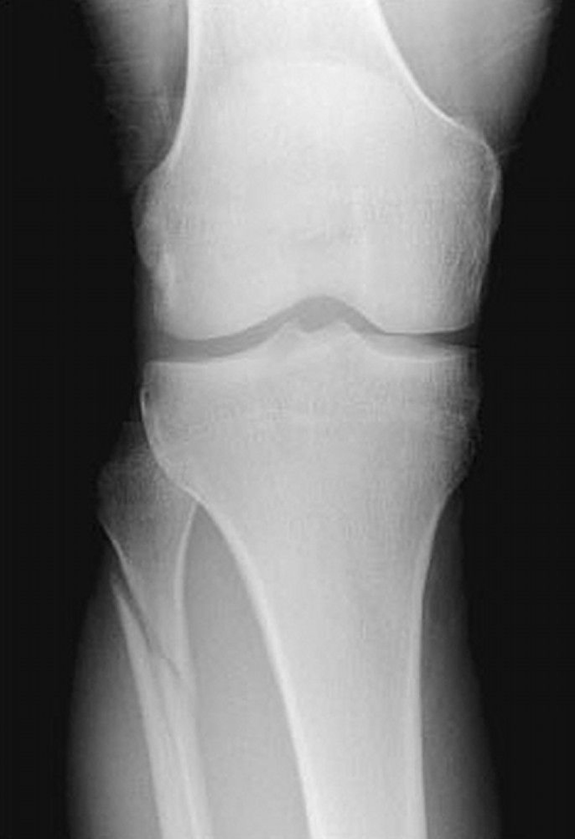 Maisonneuve Fracture (2)