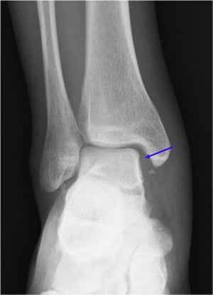 Fracture de Maisonneuve (1)