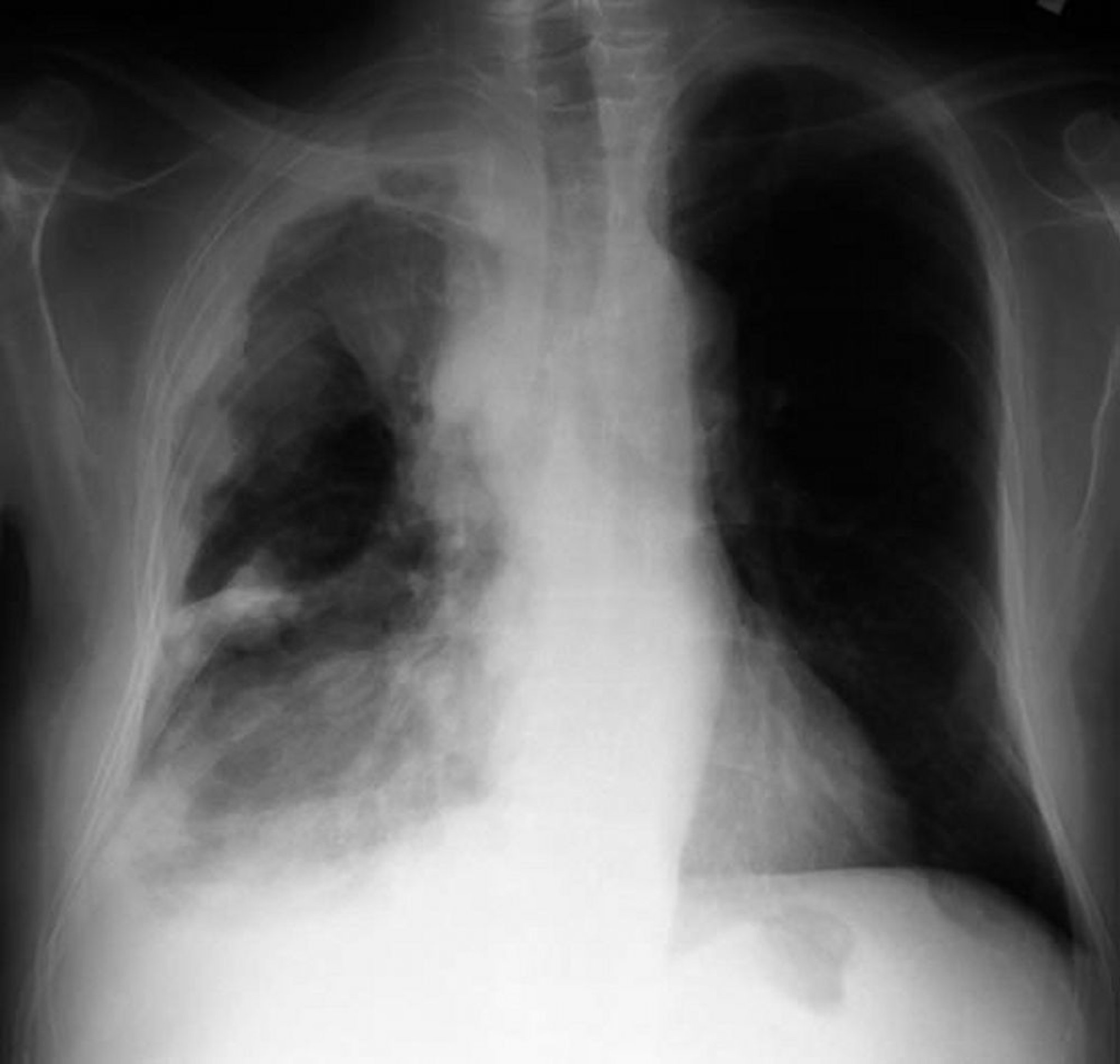 U trung biểu mô màng phổi