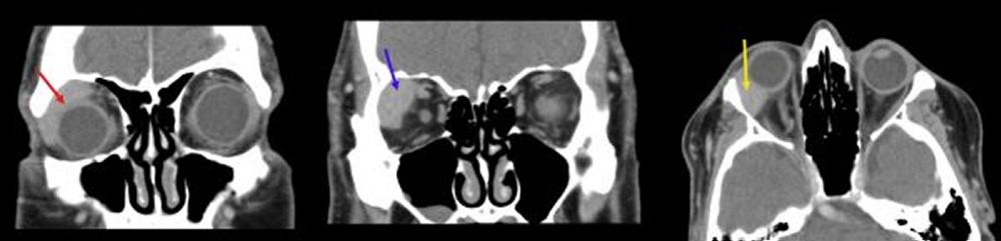 Lymphoma hốc mắt