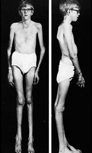 Marfan Syndrome