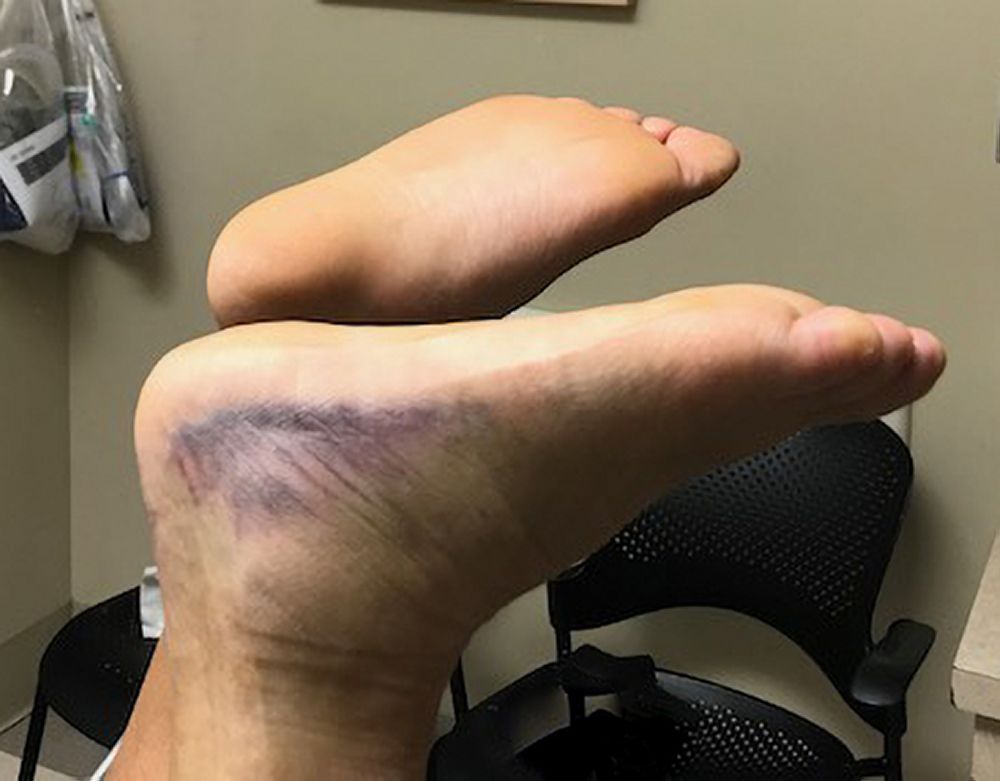 Lésions du tendon d'Achille - Blessures; empoisonnement - Édition professionnelle du Manuel MSD