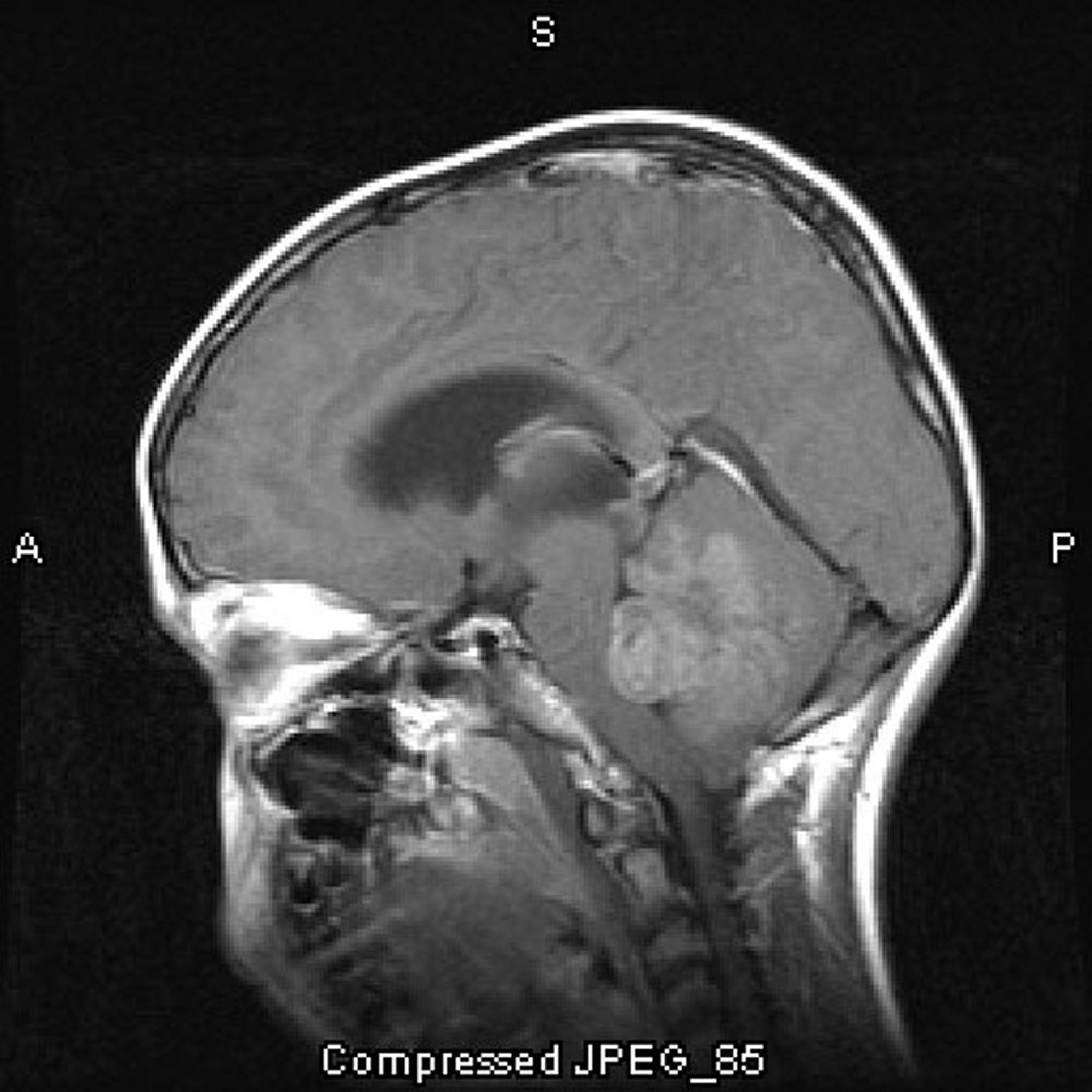 Medulloblastoma