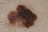 Superficial Spreading Melanoma