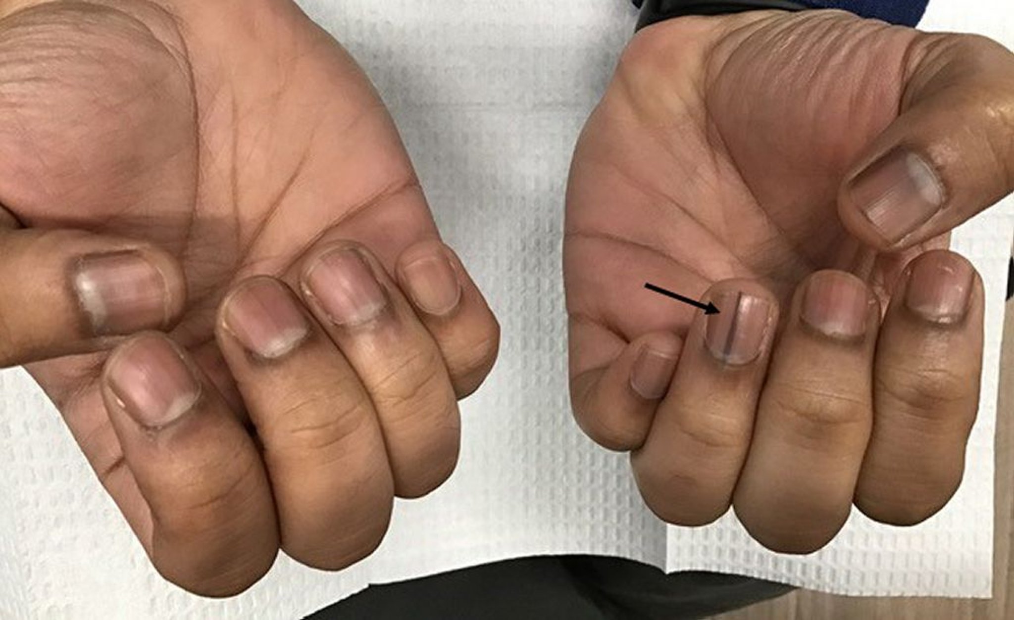 Vân sắc tố móng