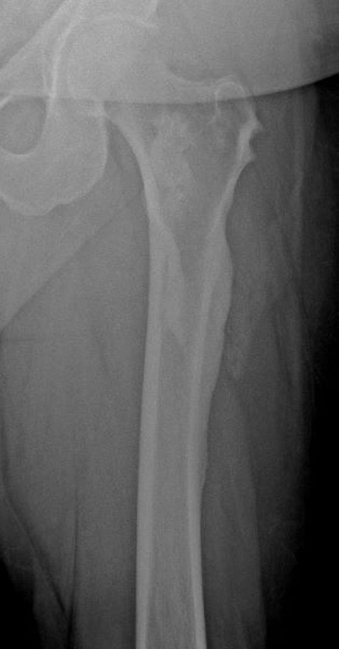 Melorreostosis (cera de vela que gotea)