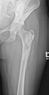 Melorheostosis (fémur y pelvis)