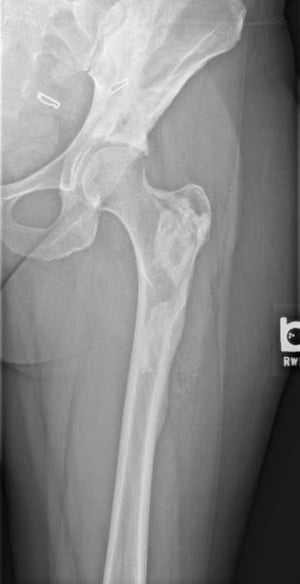 Melorheostosis (fémur y pelvis)