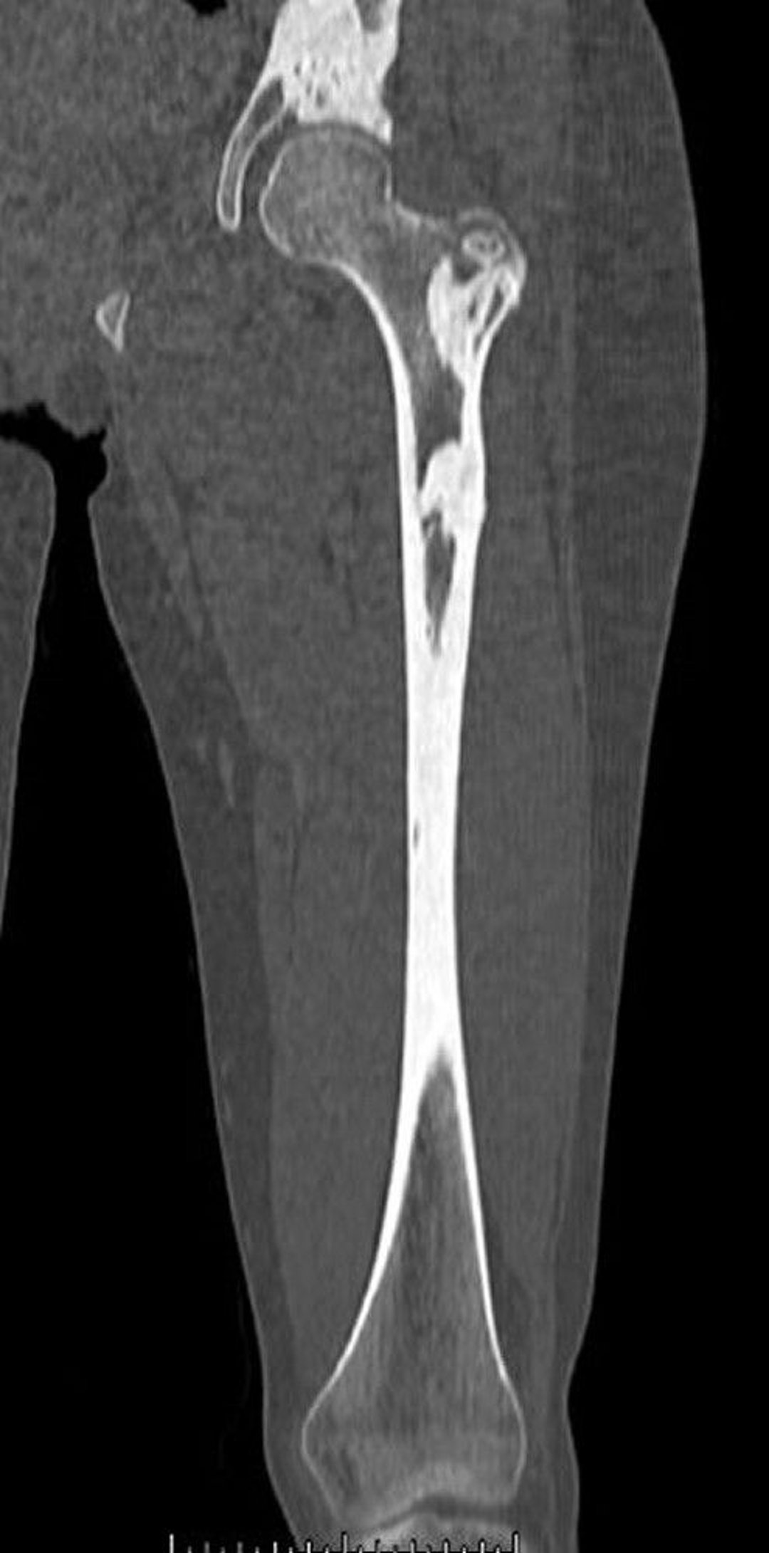 Melorheostosis (CT Scan)