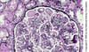 Membranoproliferative Glomerulonephritis, Immunoglobulin-/Immune Complex–Mediated