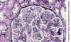 Glomérulonéphrite membranoproliférative, à médiation par les immunoglobulines/complexes immuns