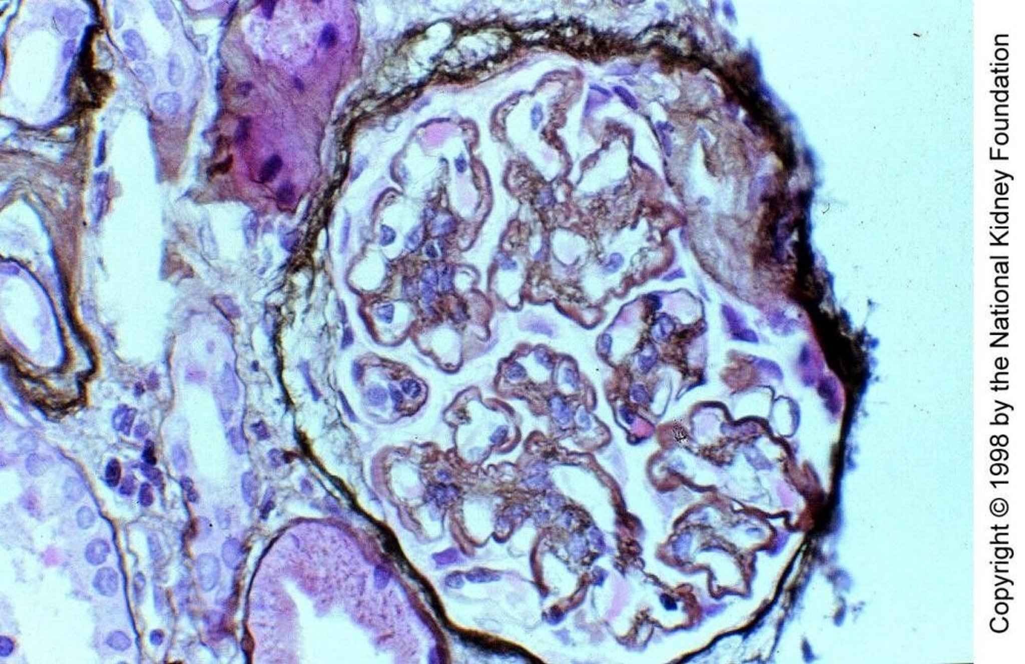 Membranoproliferative Glomerulonephritis, Complement-Mediated