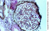 Glomérulonéphrite membranoproliférative, à médiation par le complément