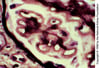 Néphropathie extra-membraneuse (spicules de la membrane basale)