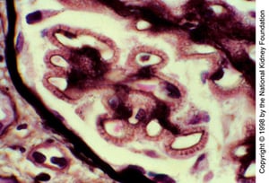 Néphropathie extra-membraneuse (spicules de la membrane basale)