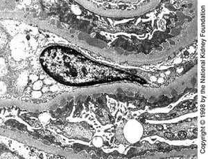 Membranous Nephropathy (Dense Deposits)
