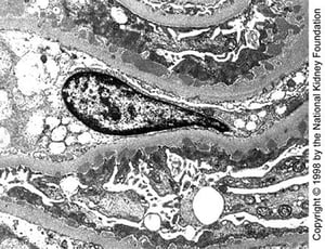 Nefropatía membranosa (depósitos densos)