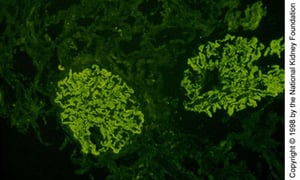 Néphropathie extra-membraneuse (dépôt d'IgG)