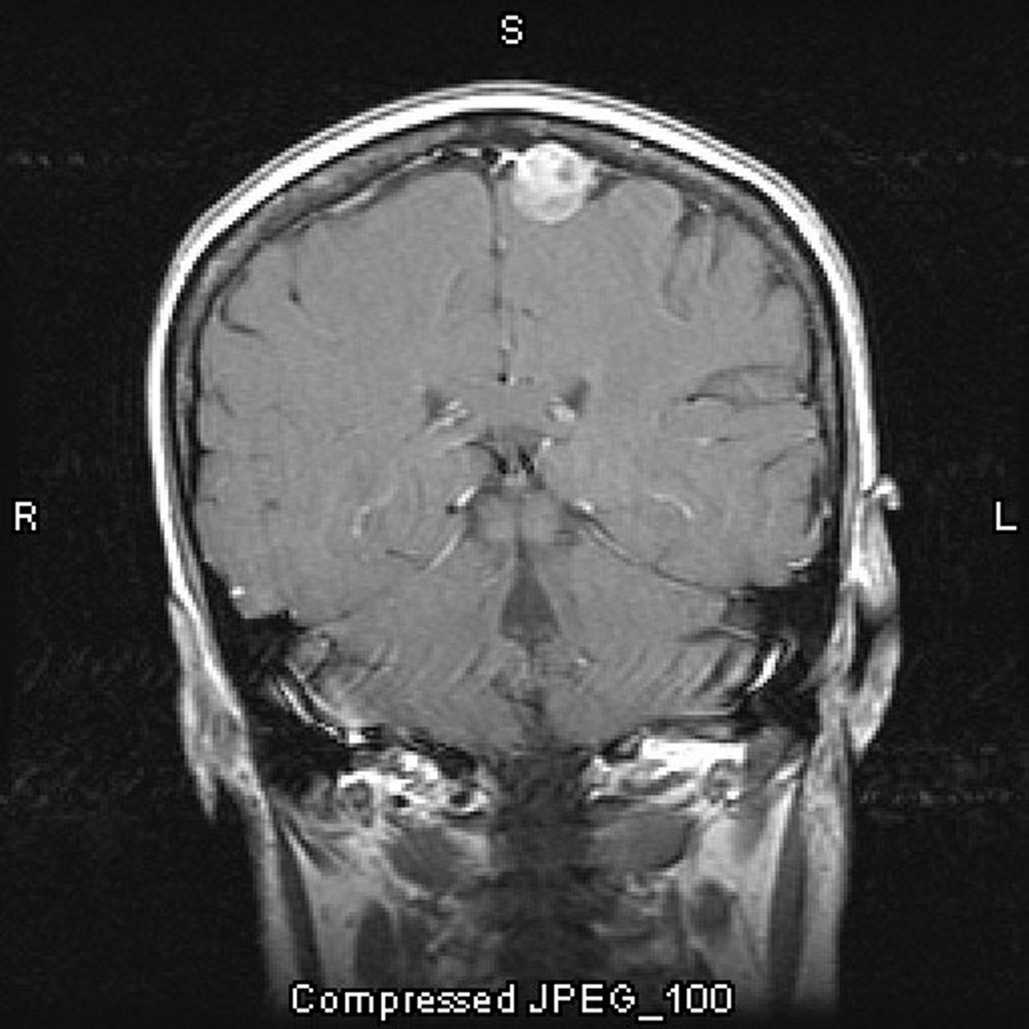 Meningioma, parassagital