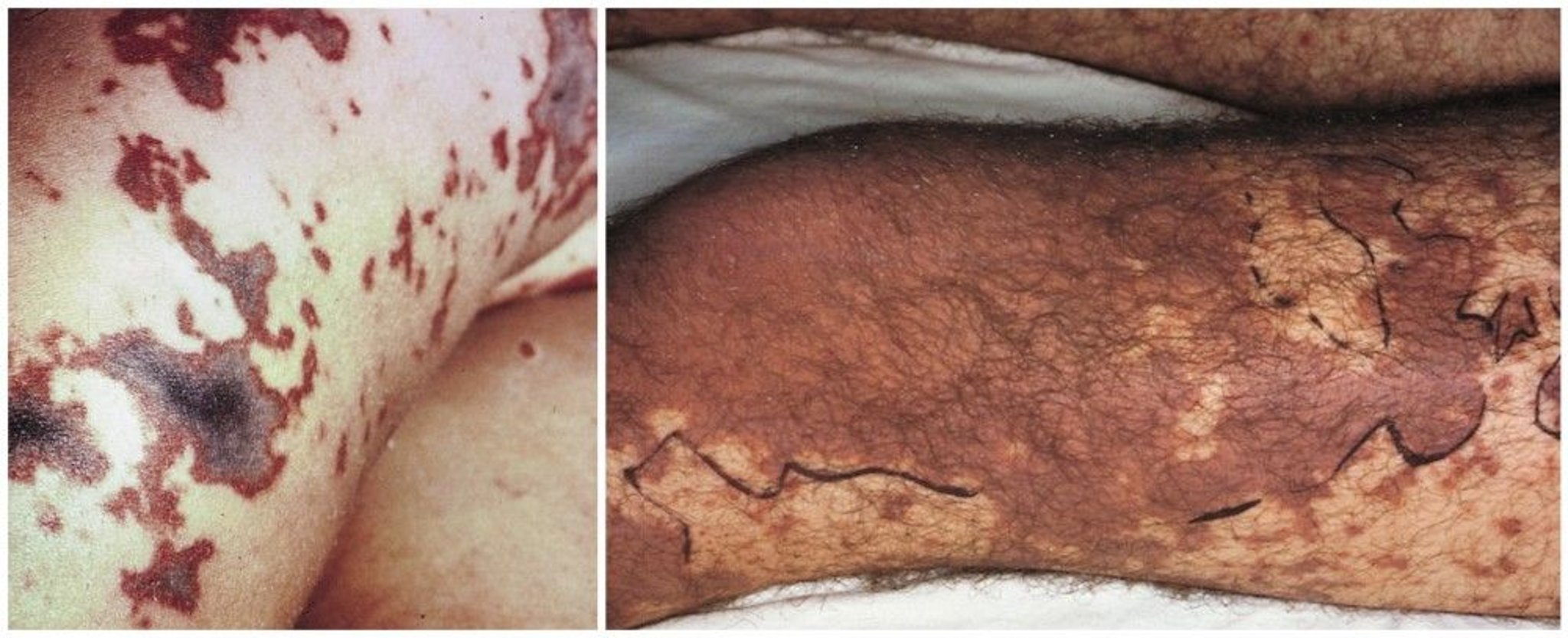 Cutaneous Necrosis Secondary to Meningococcemia