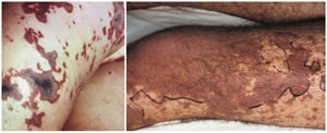 Necrosis cutánea secundaria a meningococcemia