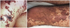 Вторичный некроз кожи при менингококкемии