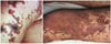 Hoại tử da thứ phát do nhiễm khuẩn huyết do Meningococcus
