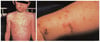 Widespread Rash Secondary to Meningococcemia