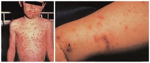 Verbreiteter Hautausschlag als Folge einer Meningokokkämie