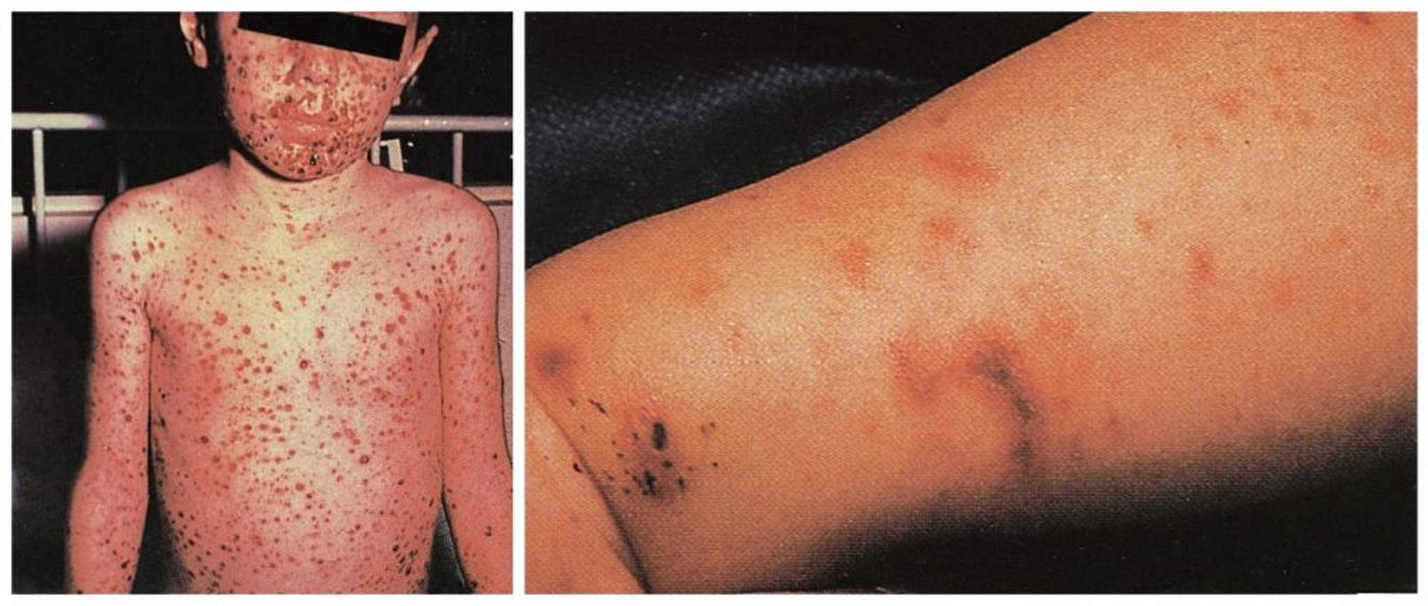Widespread Rash Secondary to Meningococcemia