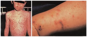 Phát ban trên diện rộng thứ phát do nhiễm khuẩn huyết do Meningococcus
