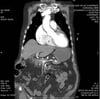 Ischemia mesenterica (Angio-TC)