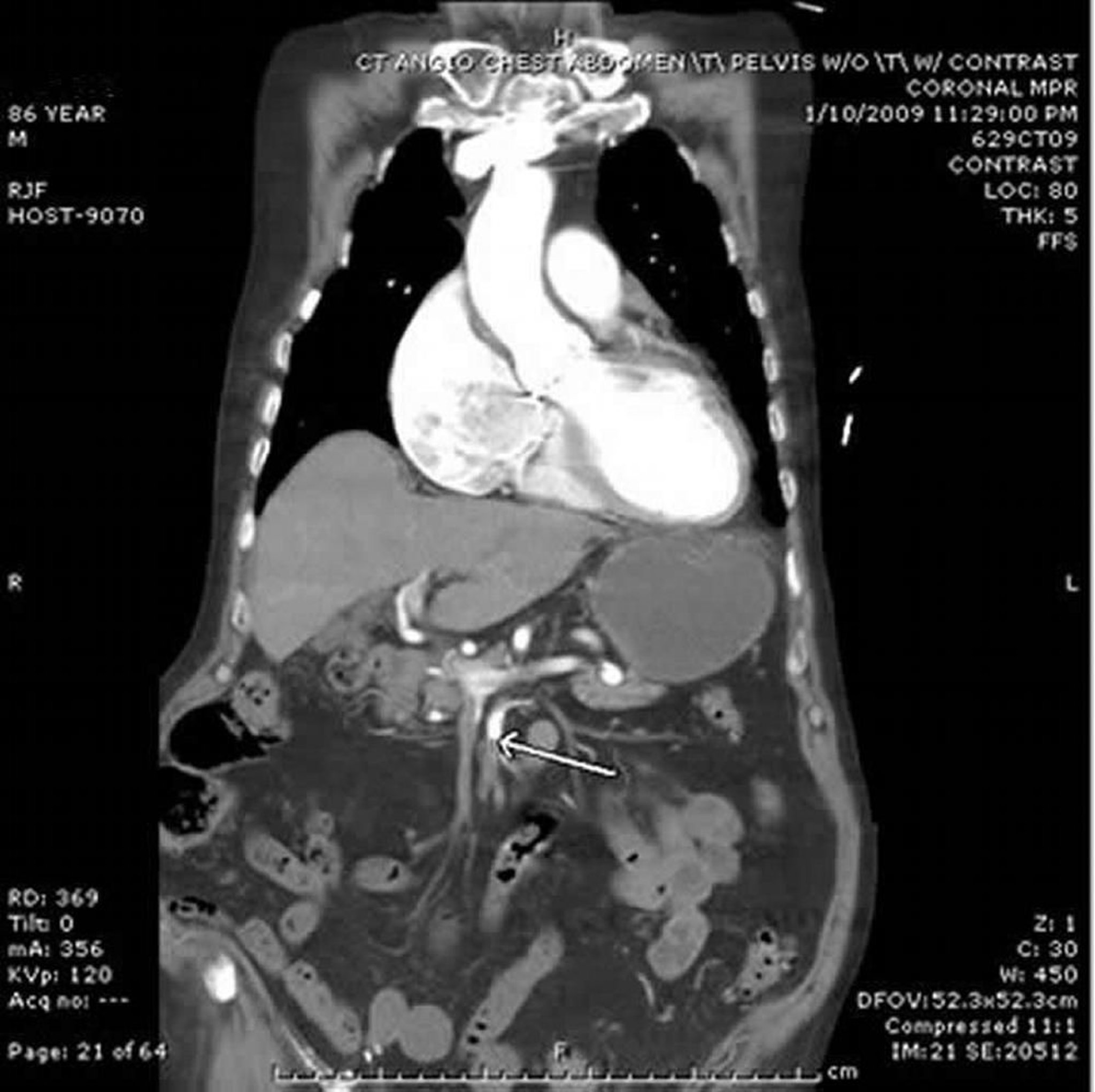 Ischemia mesenterica (Angio-TC)