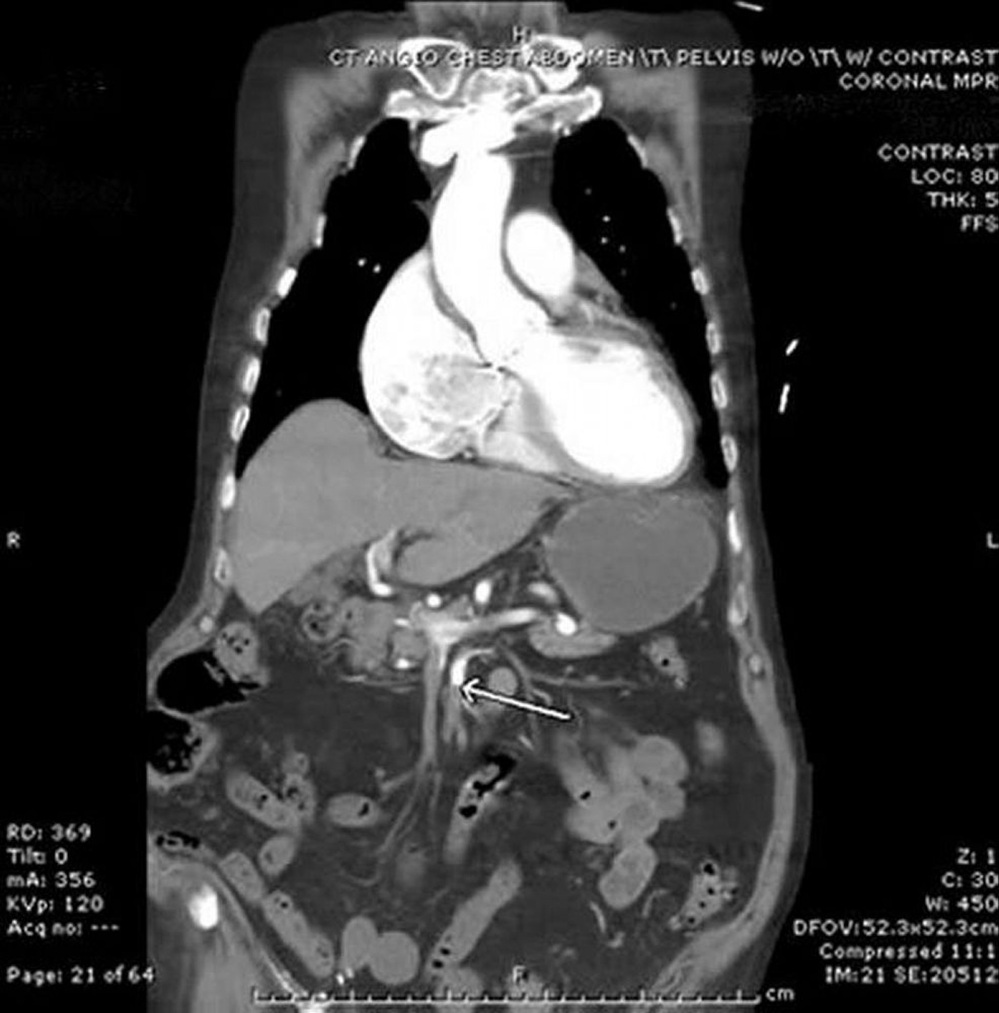Isquemia mesentérica (angiografia por TC)