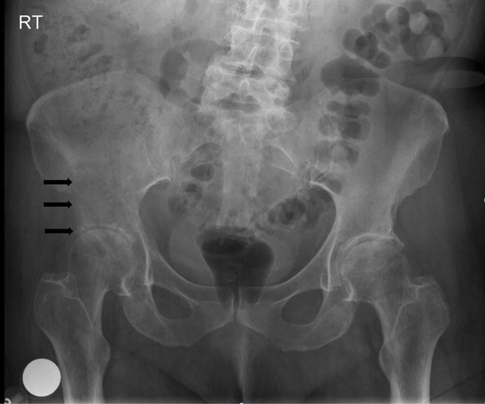 Metastatic Bone Tumor