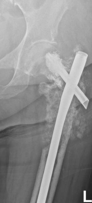 Enfermedad metastásica femoral proximal con tratamiento quirúrgico fallido