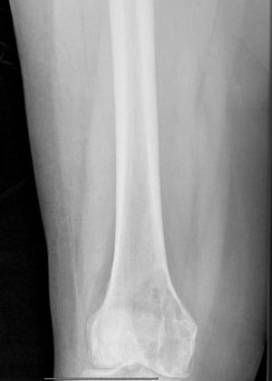 Metástasis líticas en el fémur distal