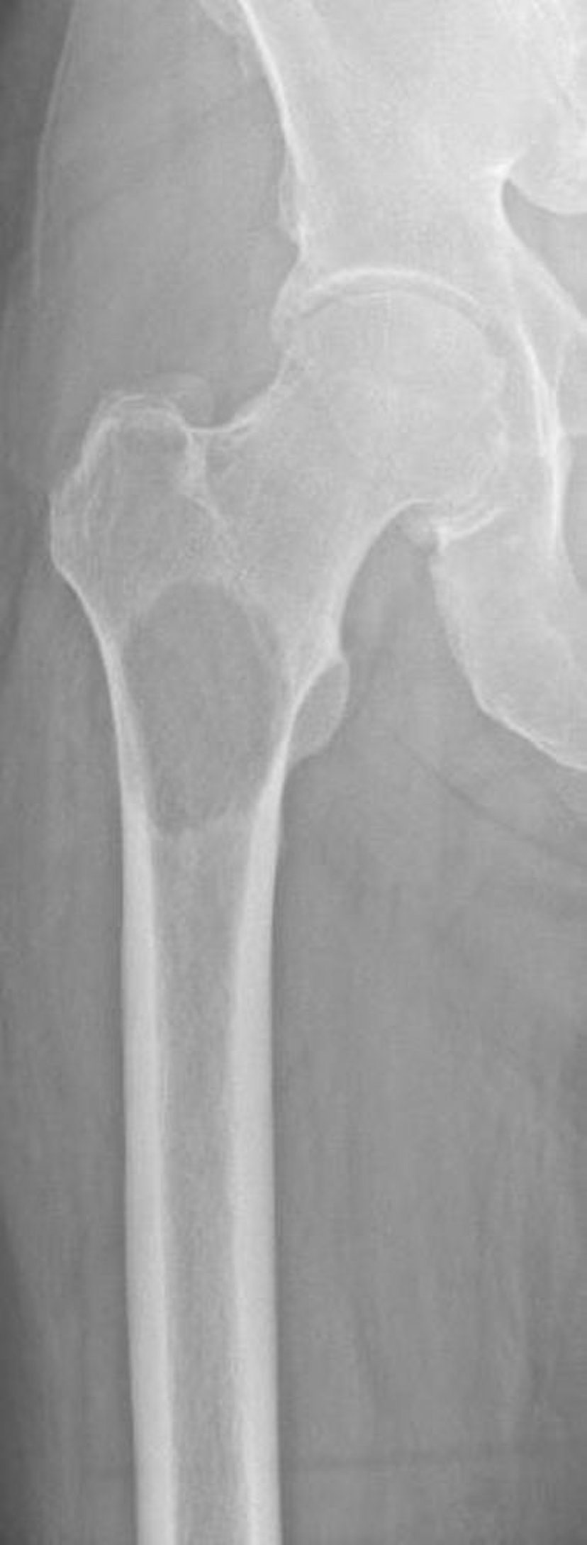 Metástasis líticas en el fémur proximal