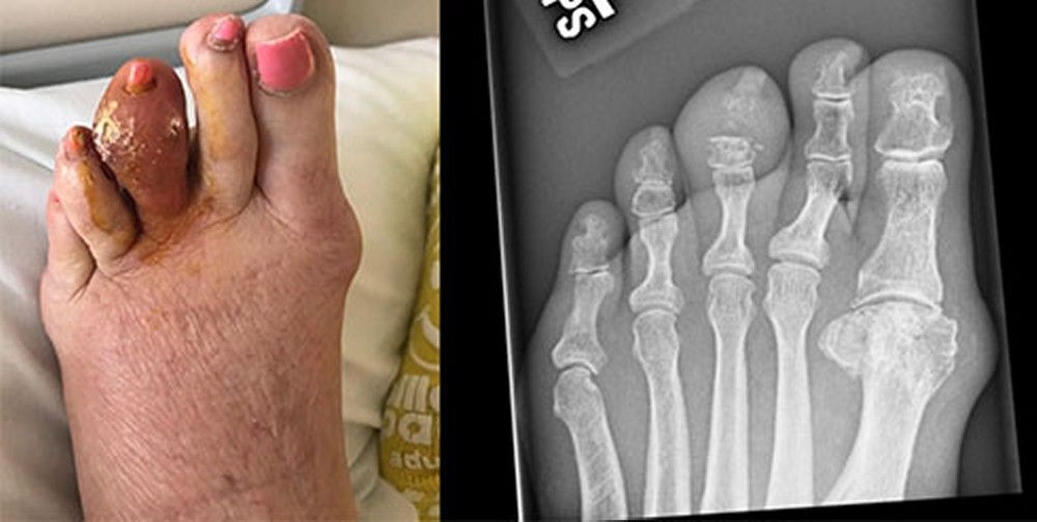 Gout of the Middle Toe