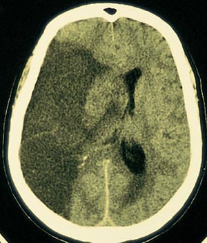 Infarctus de l'artère cérébrale moyenne (fréquent)